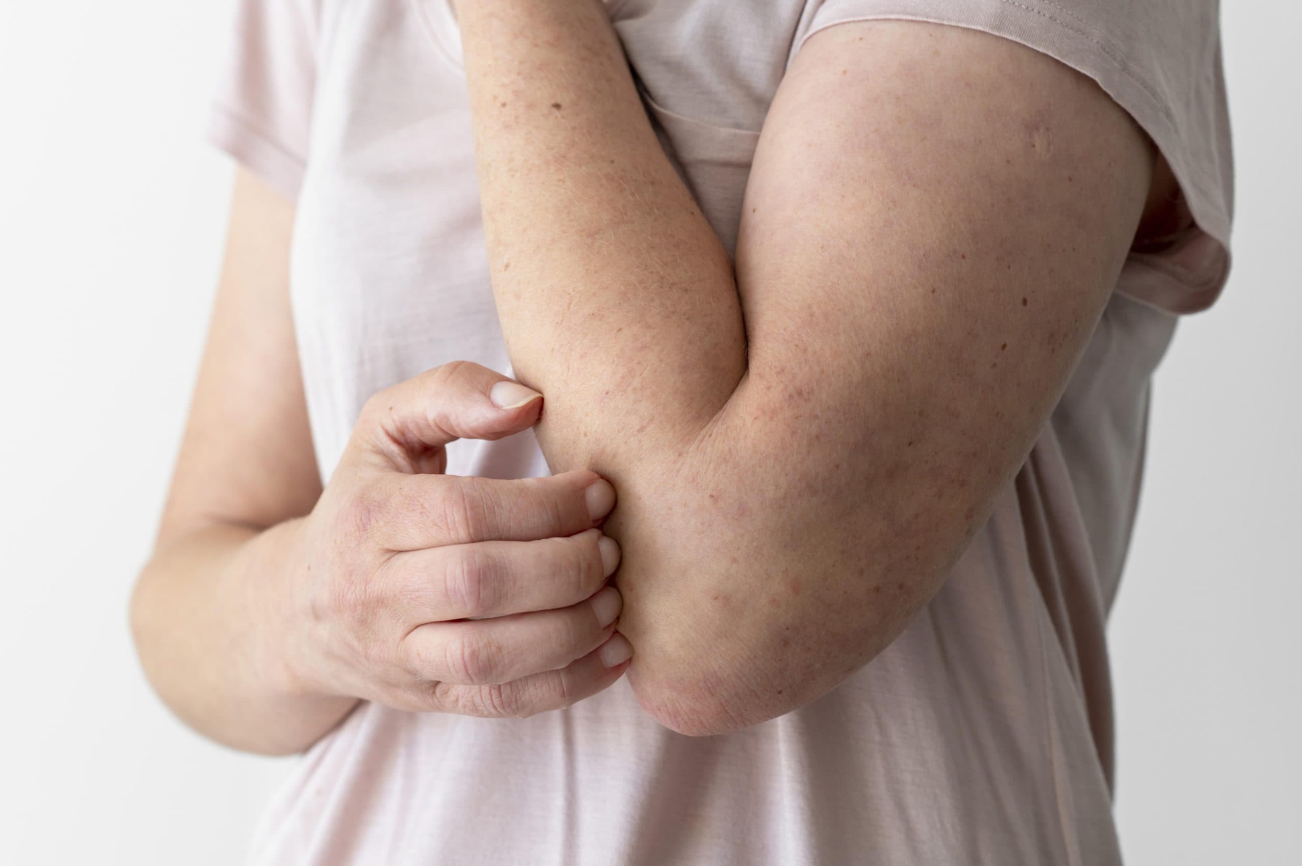 Casos de herpes-zóster subiram 35% após pandemia de Covid, diz estudo