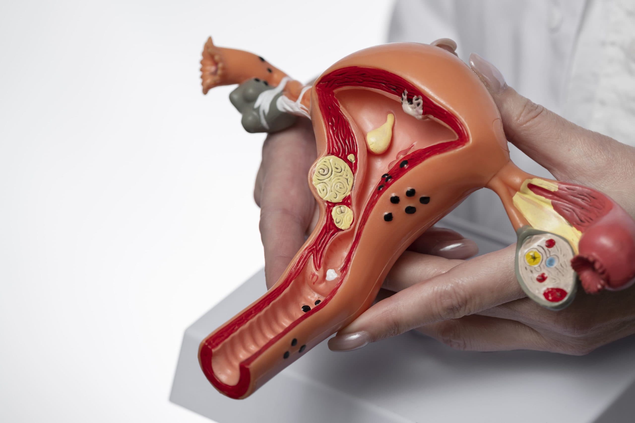 Câncer do colo do útero: mulheres com ansiedade e depressão têm mais chances de desenvolver a doença