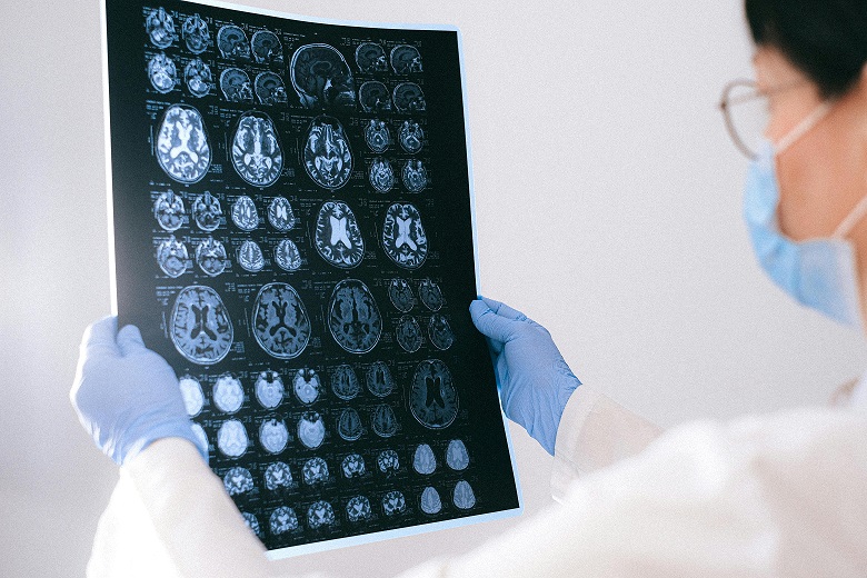 Alzheimer: os primeiros sinais que merecem atenção para um diagnóstico precoce